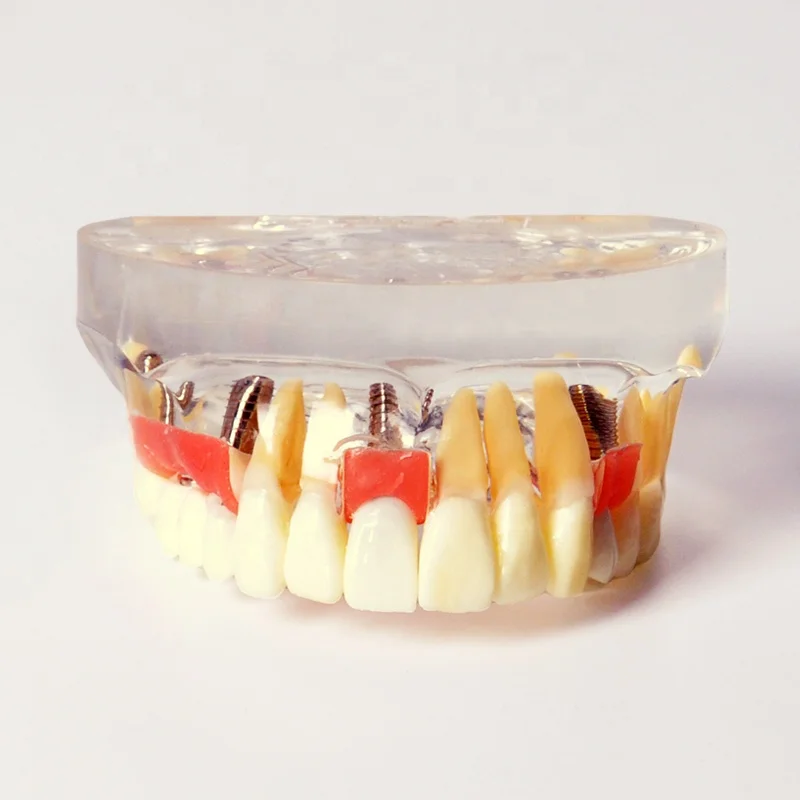 Демонстрационная модель имплантации с одной короной и мостом