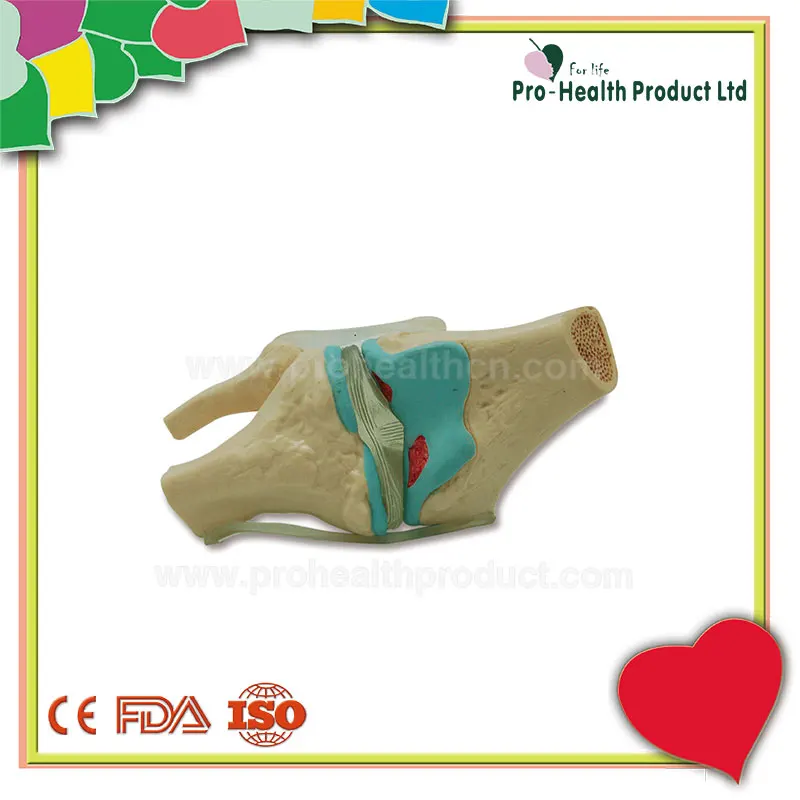 Joint Disease Knee Lesions Arthritis Knee Osteoarthritis Model Four Stage Degenerative