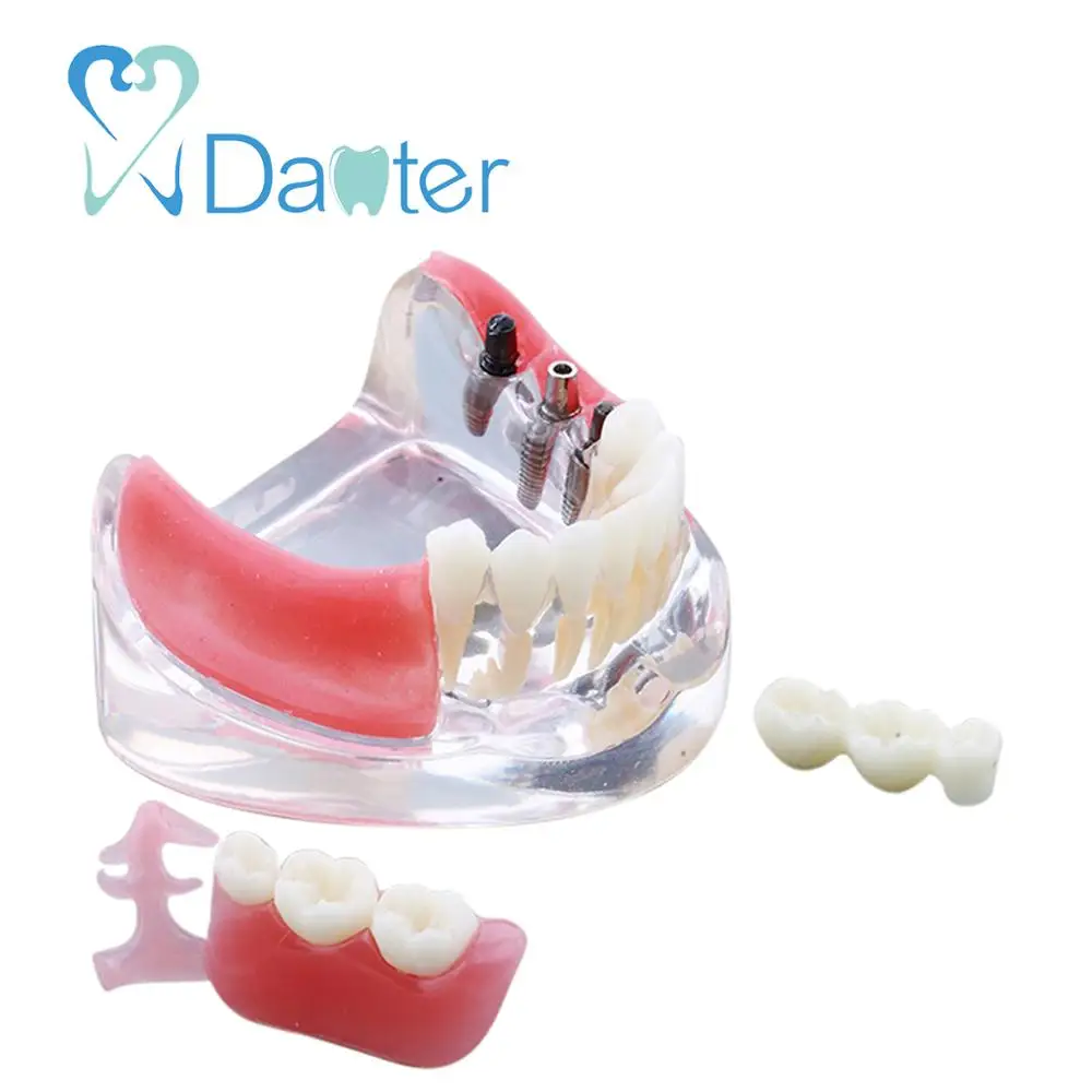 New Design Dental Implant Model with Restoration Dental Teaching Model