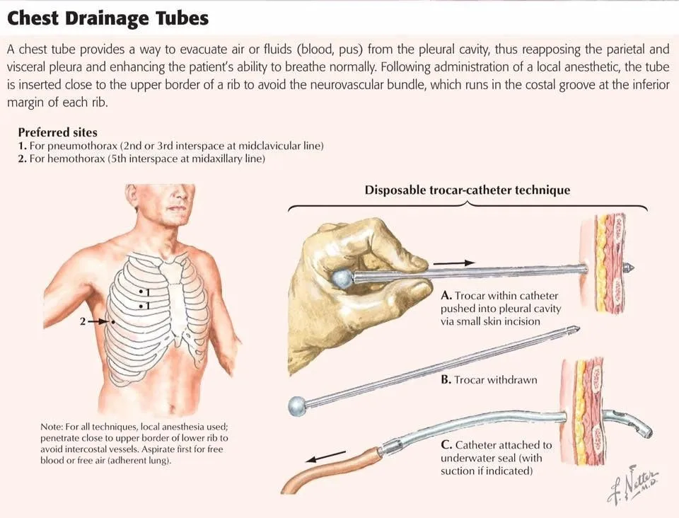 OME chest tube with trocar for thoracic surgery CE ISO