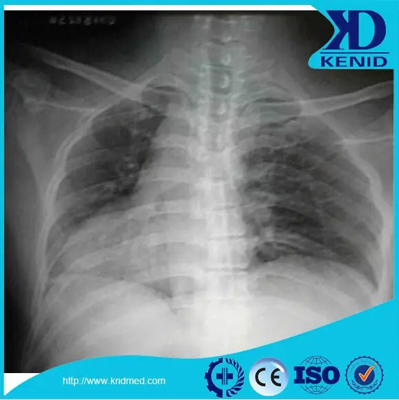
KND A/F Dry X Ray Film for DSA/MRI Agfa Medical Fuji Diat Thermal Flim 