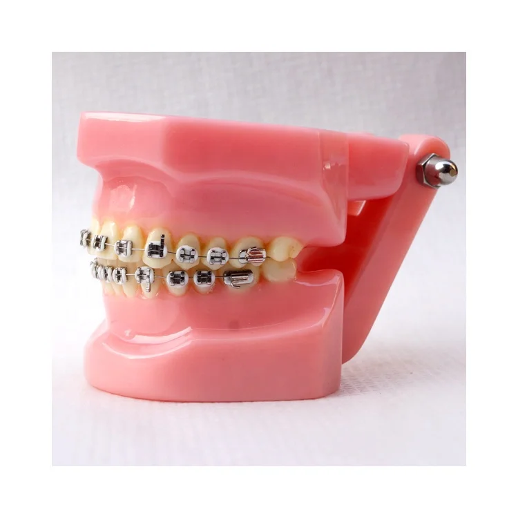 Dental Orthodontic model With metal brackets