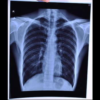8*10 Inch Blue Base Inkjet Printing X Ray Medical Film
