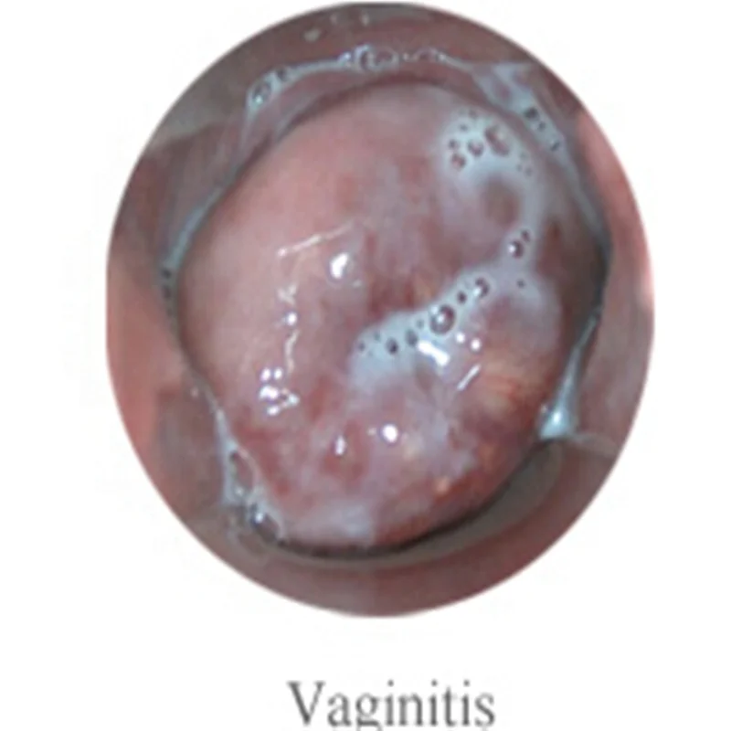 
Electronic Handheld Video Colposcope Price Colposcopy For Uterine Examination 