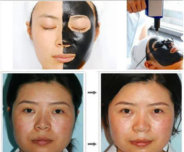 Best price mini Q Switched Nd Yag Laser Tattoo Removal Machine