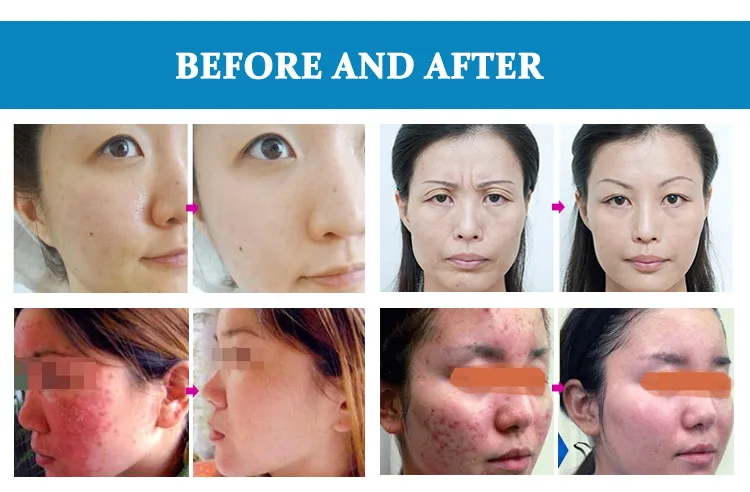 Best sellers in europe 2018 pdt led light therapy face