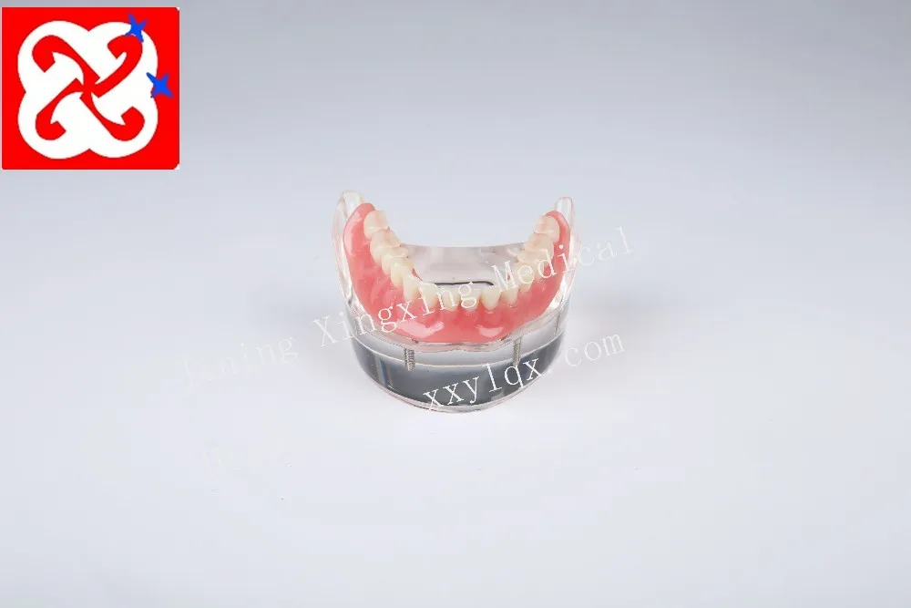 Mandibular overdenture имплантат зубов с 4