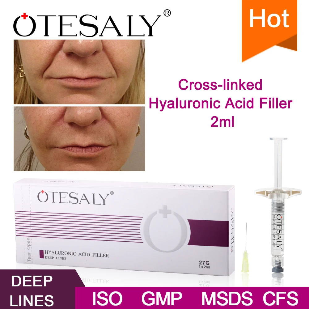 
CE Approved OTESALY Hyaluronic Acid Injectable Dermal Filler for Nasolabial Folds Volume 