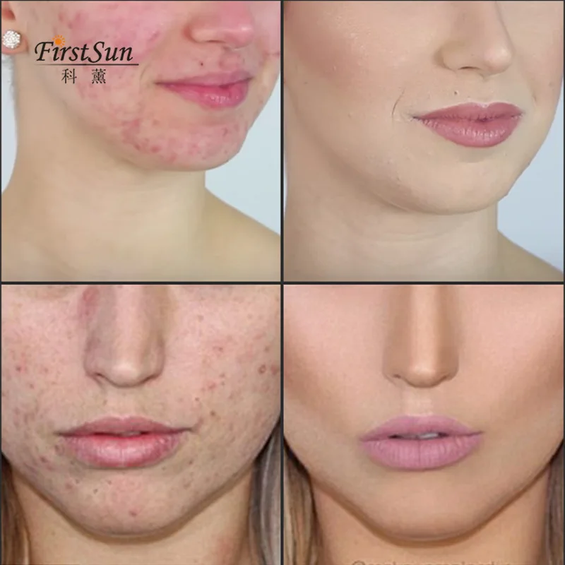 100% Pure Natural Organic Moisturizing Acne Treatment Tea Tree Essential Oil For Oily And Acne Skin