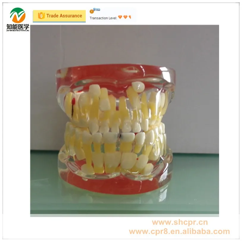 BIX-L1006 Transparent baby teeth pathological dental model