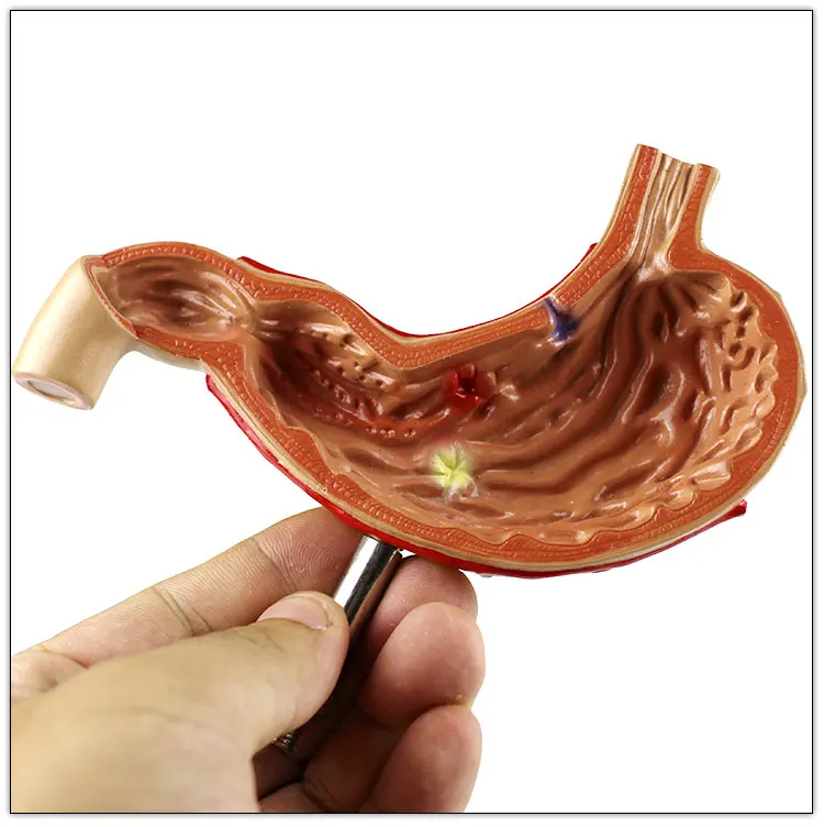 Stomach-Pathological gastric ulcer  Human Digestive System Medical Teaching Anatomical Model visceral model