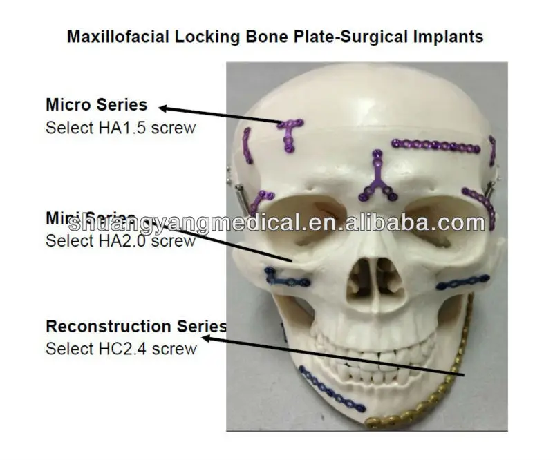 хирургические инструменты- челюстно-лицевой т- образный блокировкой костные пластины