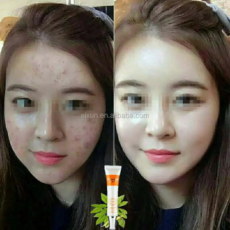 Hot Sale!! Herbal Formula Anti Pimples Beauty Care Acne Melasma Cream