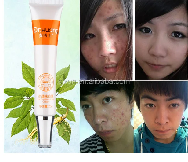 Hot Sale!! Herbal Formula Anti Pimples Beauty Care Acne Melasma Cream