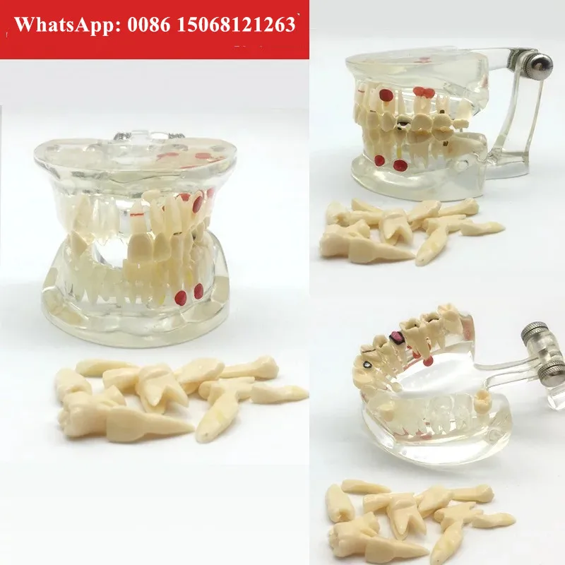 ALS Dental ceramic orthodontic Braces tooth model with Bracket