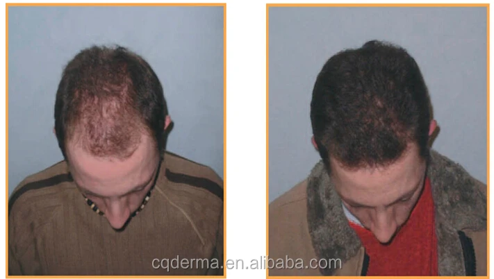 Hot selling hair loss treatment professional hair device