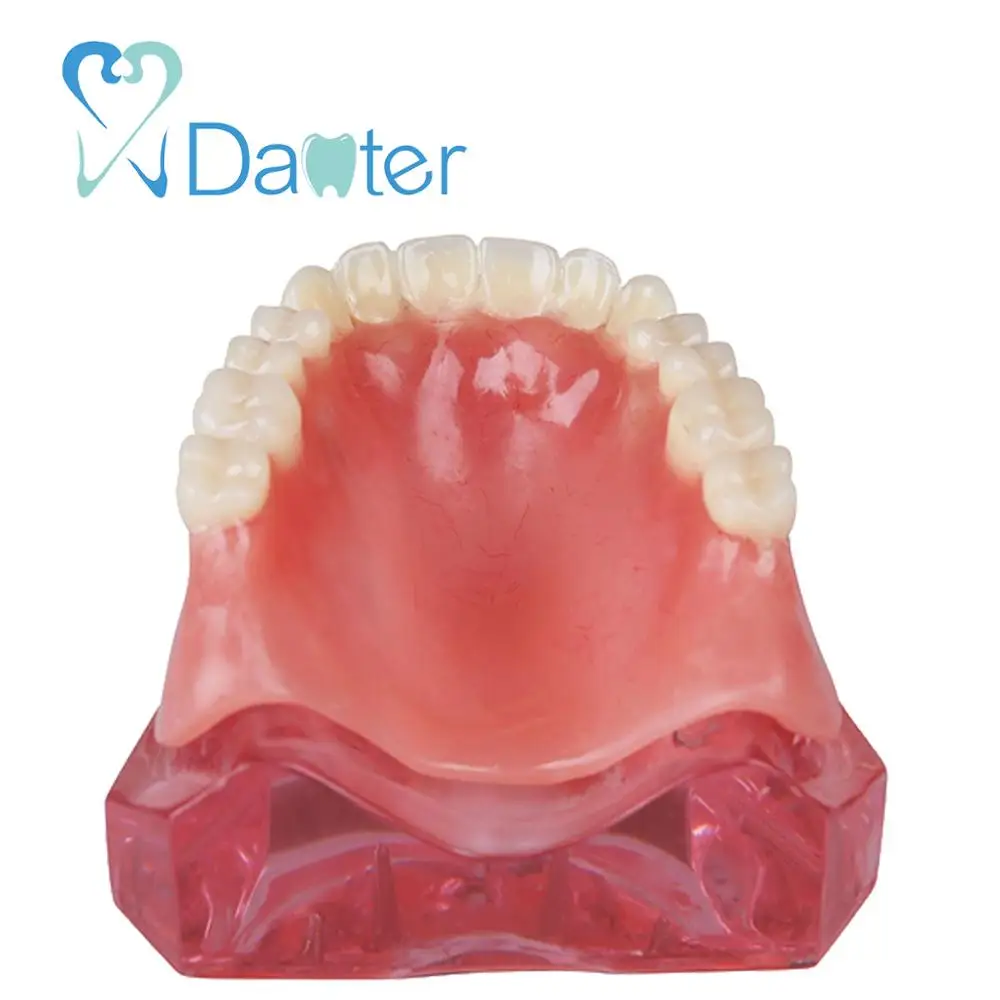 Newest Dental Overdenture Model Interior Maxillary with 4 Implant Restoration for Dental Study