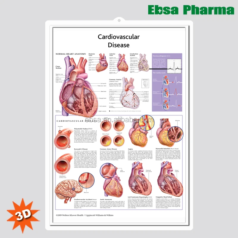3D Medical Human Anatomy Wall Charts / Poster-Cardiovascular Disease
