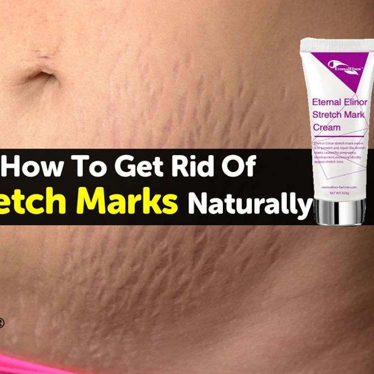 Крем Для Удаления растяжек, гель для взрослых, женский крем для отбеливания, индивидуальная этикетка, уход за кожей, OEM 3 года, 100 г, 10 шт.