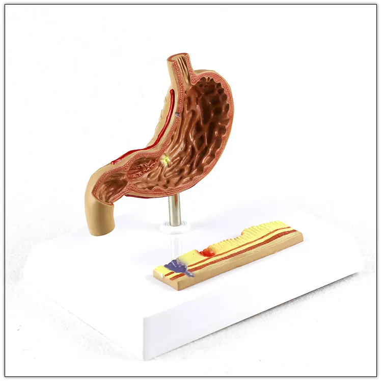 Stomach-Pathological gastric ulcer  Human Digestive System Medical Teaching Anatomical Model visceral model