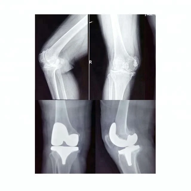 
Primary total knee replacement joint prosthesis 