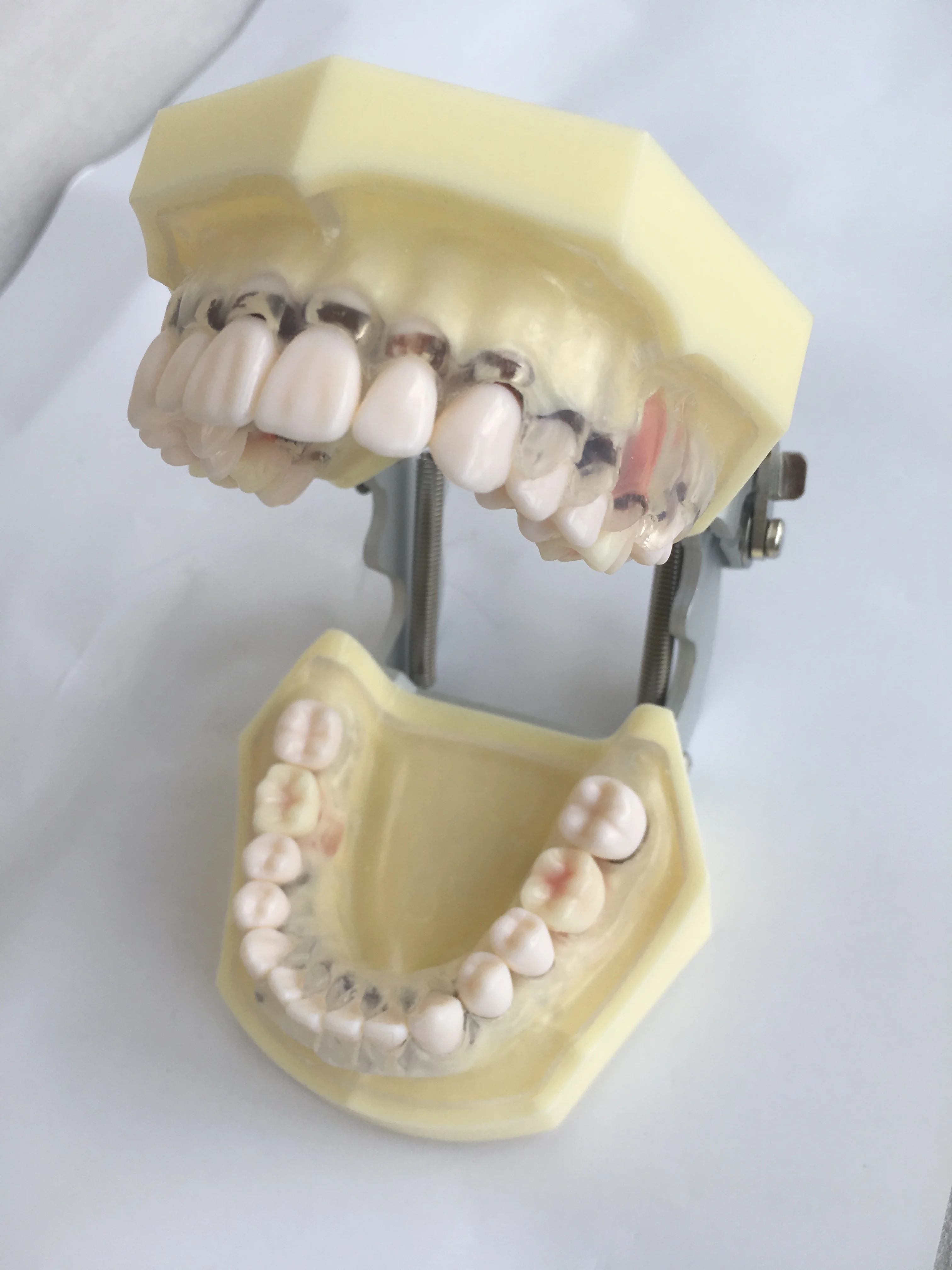 Peroidontal disease dental model with transparent clear gum demostrates ginivae recession