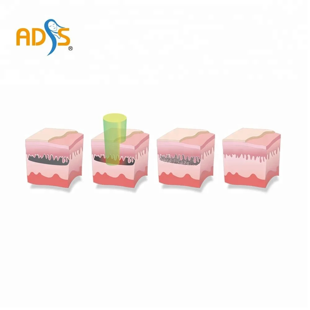 ADSS Q-switch laser tattoo removal and skin rejuvenation with carbon laser peeling