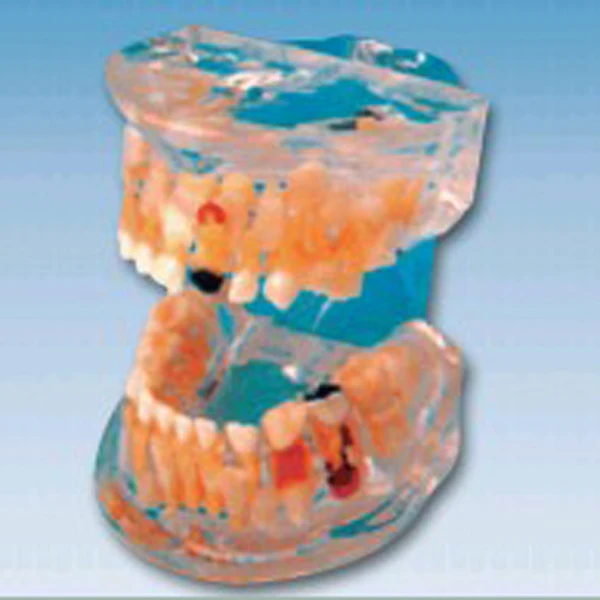 BIX-L1006 Transparent baby teeth pathological dental model