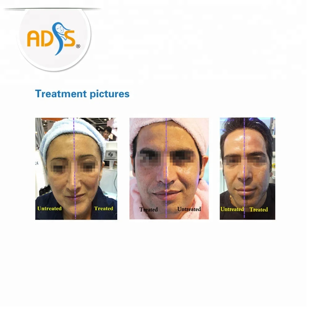non-invasive face lifting HIFU machine