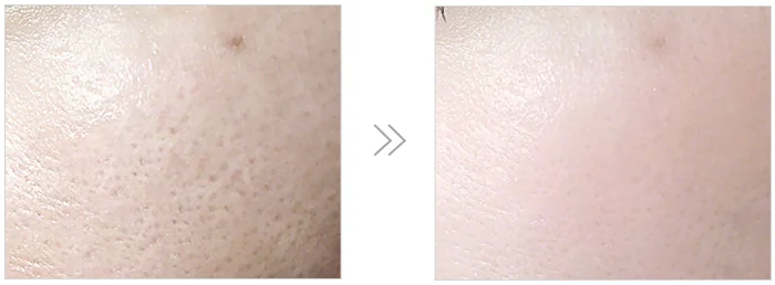 South Africa Skin Whitening and Bleahing Cream for Black Skin