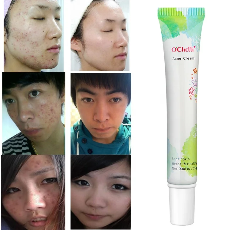 One Day Can See Effect Best Quality Benzoyl Peroxide Acne Cream