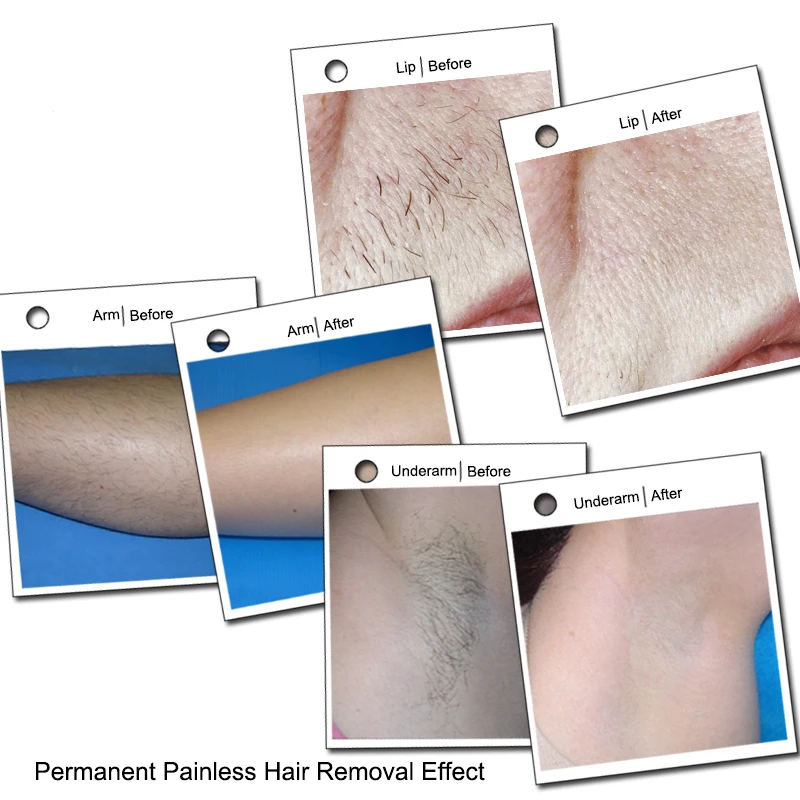 KES hot sale distributing laser soprano ice/ laser alma soprano ice price/ soprano laser hair removal machine MED-808