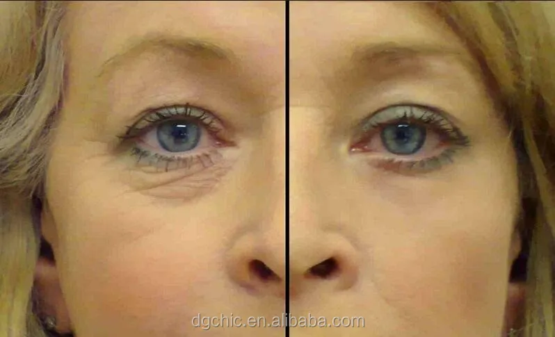 
Silicone Patches Reusable Facial Anti Wrinkle Pads Face Pads Eliminate Prevent Chin Eye Forehead Wrinkle Pads 