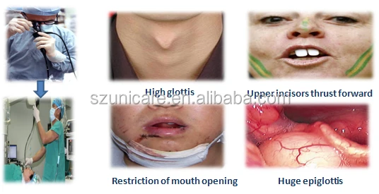 electronic video endoscope flexible fiber optic laryngoscope set