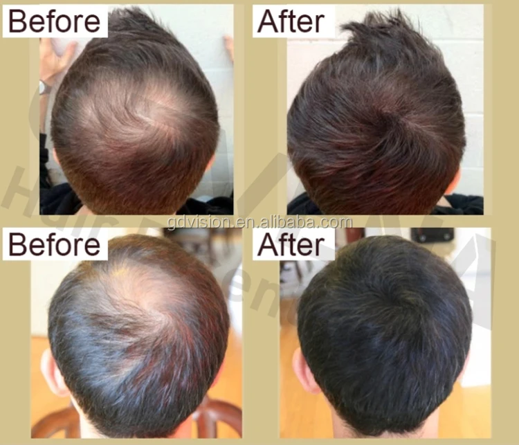 hair growth serum anti loss product OTVENA oil