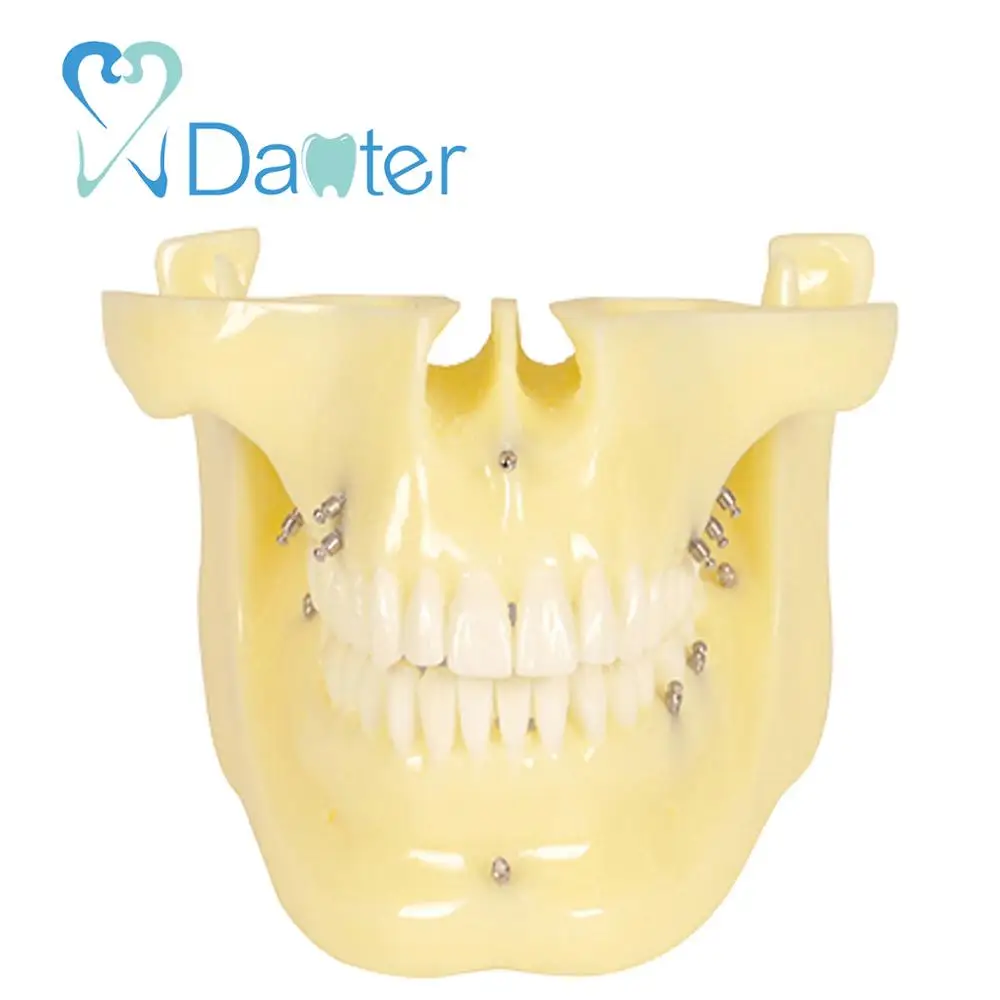 China Dental Implants Dental Orthodontic Model with Ortho Implant