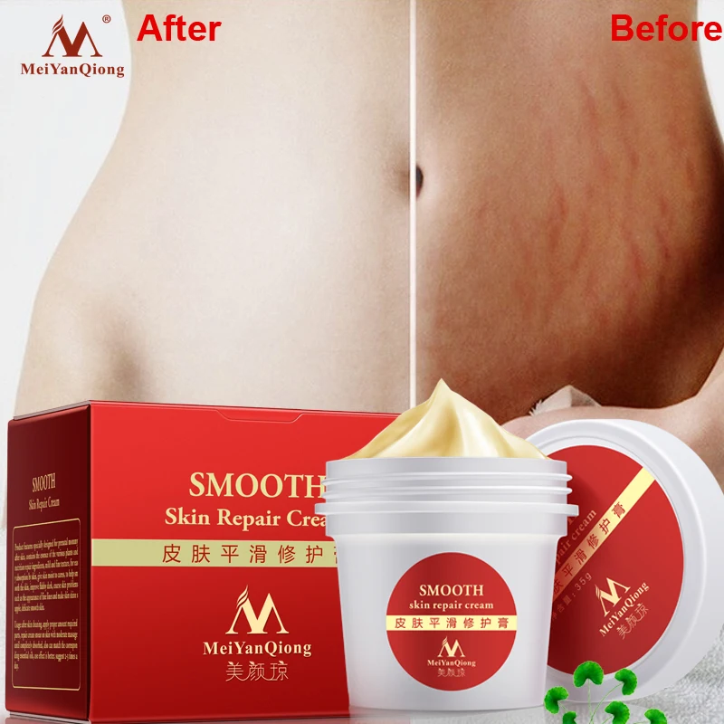 
High Quality Smooth Skin Cream For Stretch Marks Scar Removal To Maternity Skin Repair Body Cream Remove Scar Care Postpartum High Quality Smooth Skin Cream For Stretch Marks Scar Removal To Maternity Skin Repair Body Cream Remove Scar Care Postpartum