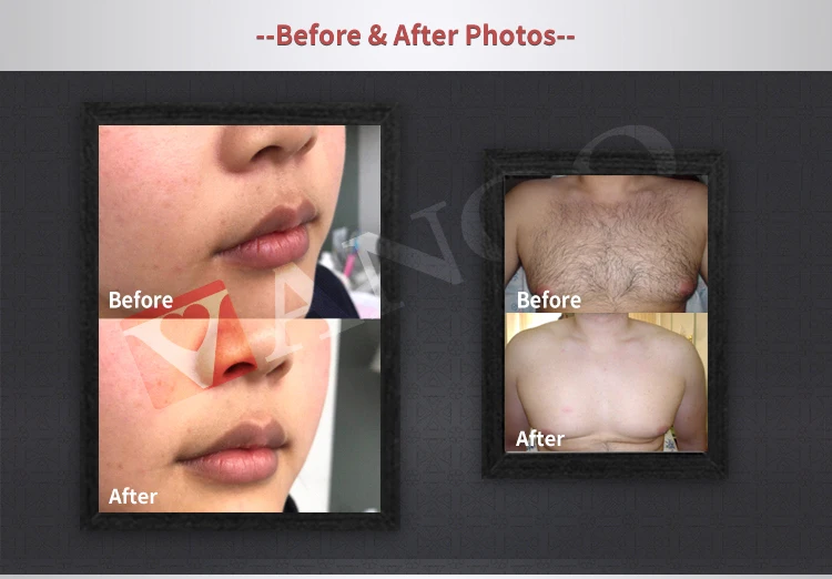 808 diode laser hair removal/fast Permanent beauty machine/permanent laser hair removal diode laser 1200W