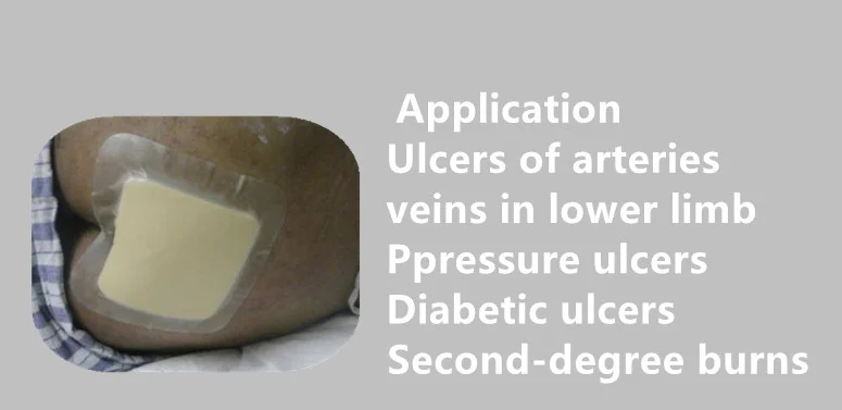 Medical Hydrocolloid Foam Pad Wound Dressing Safety Features Ultrasonic Disinfecting for Wound Care