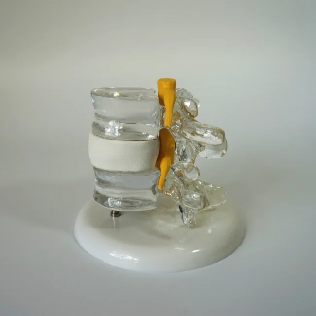 R020935 Crystal Transparent Vertebral Simulator, Lumbar Disc Herniation Model