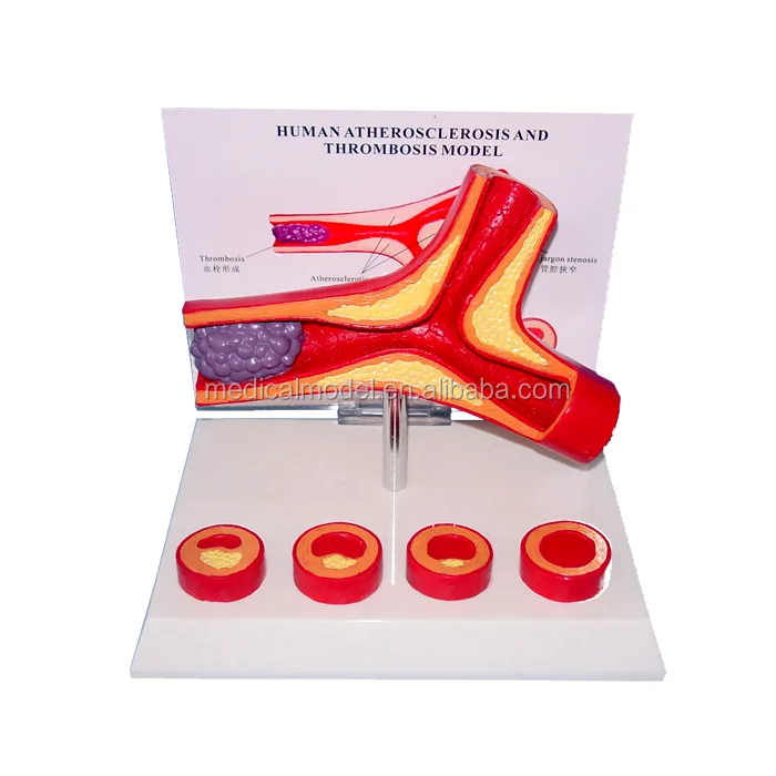 Human Artery Atherosclerosis and Thrombosis Model