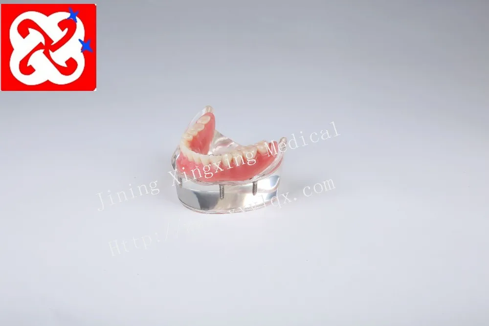 Mandibular overdenture имплантат зубов с 4