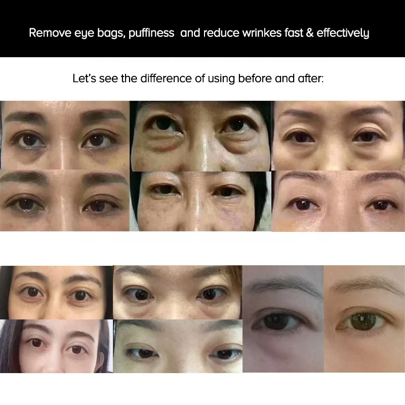 instant reducing puffiness dark circles wrinkles eye bags non surgical lifting syringe ageless eye serum