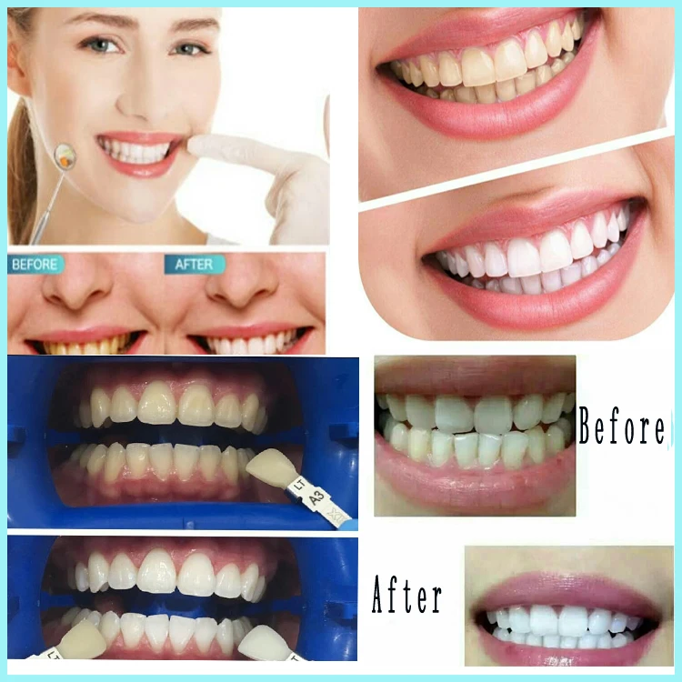 professional led teeth whitening machine