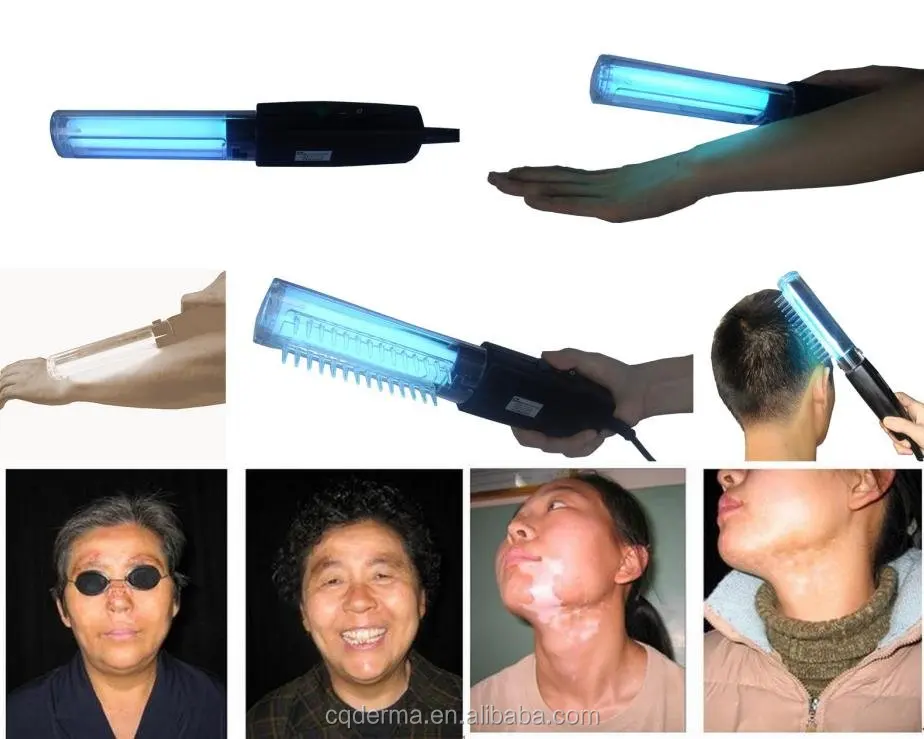 Anti-vitiligo uv therapy lamp- Psoriasis, Vitiligo, Eczema, Atopic Dermatitis
