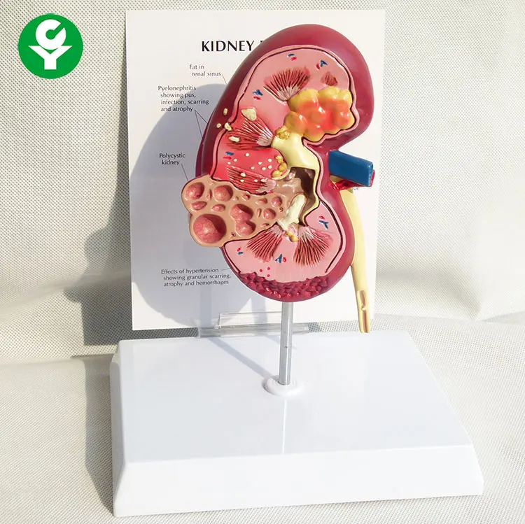 Advanced Renal Anatomy Model Renal Health Pathology Model Teaching Model
