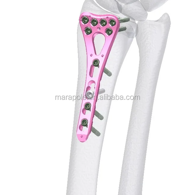 Травматические имплантаты костные пластины и винты ортопедические хирургические