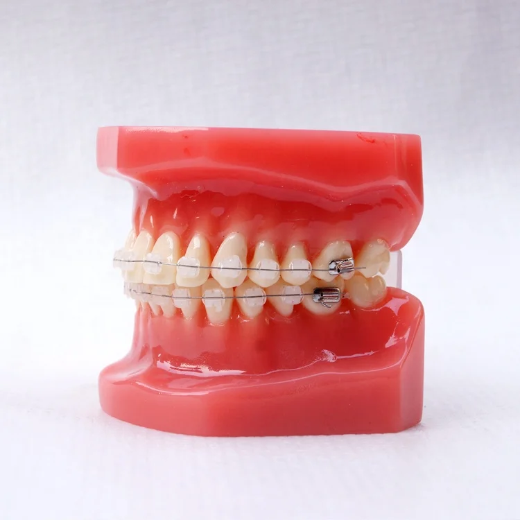 Dental Orthodontic model With metal bracket