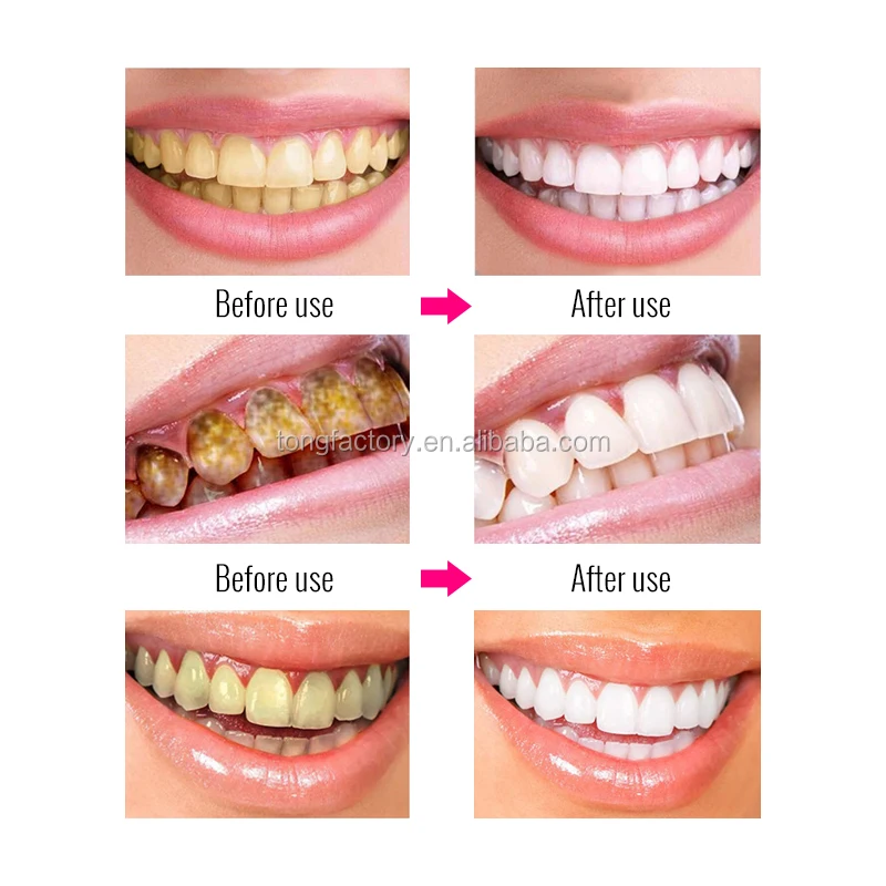 Лидер продаж, отбеливающий отбеливатель зубов Omy Lady от частного бренда для оптовой продажи