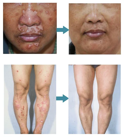 UVB Lamps- Psoriasis, vitiligo clinic machine uv lamp technology for the patient